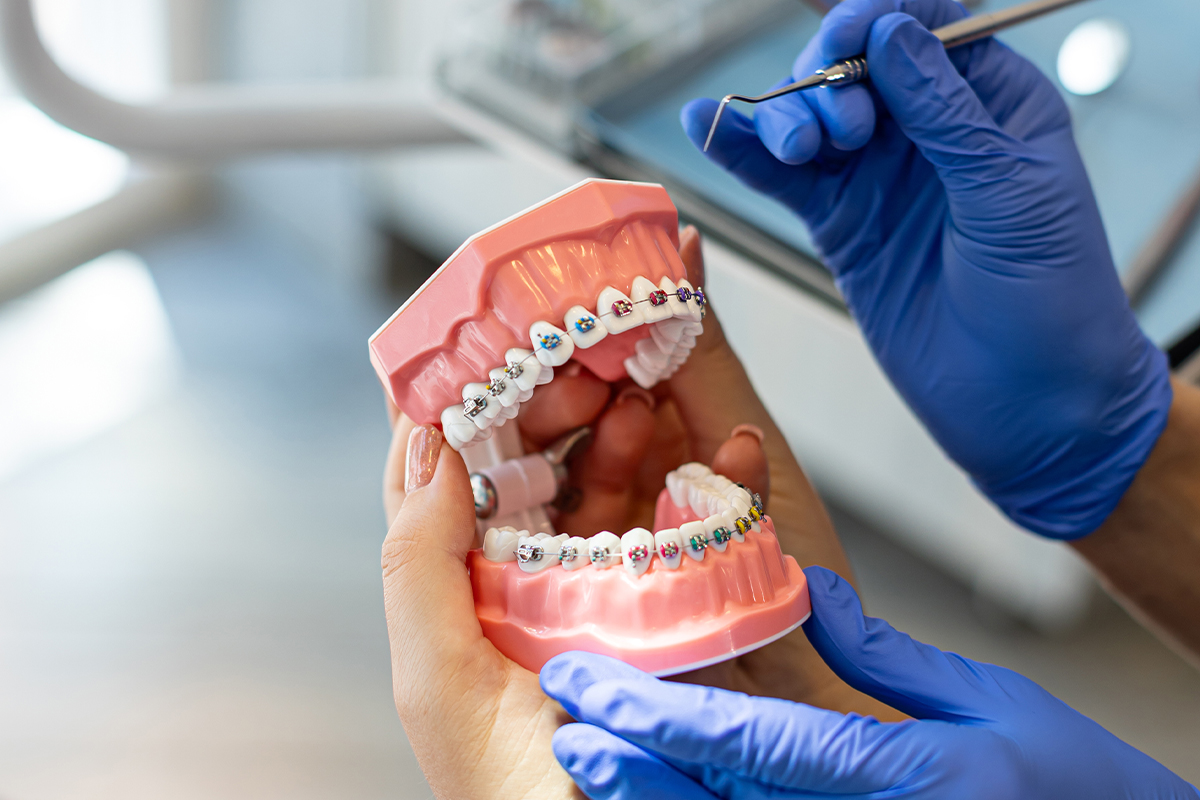 Mire kell figyelni a fogszabályozó készülék ragasztása után?